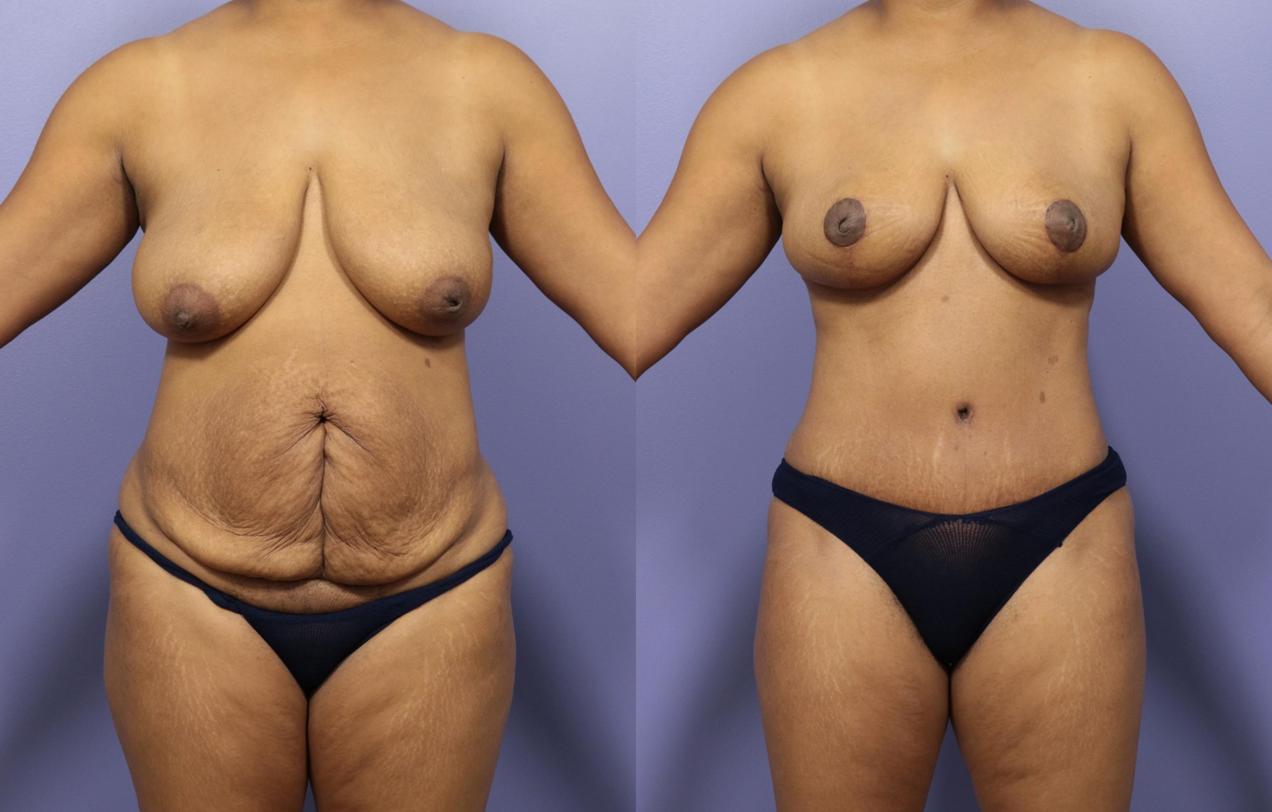 Como é a recuperação da mommy makeover