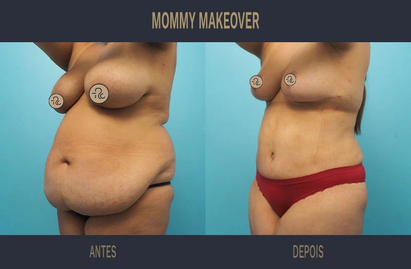 Como é a recuperação da mommy makeover