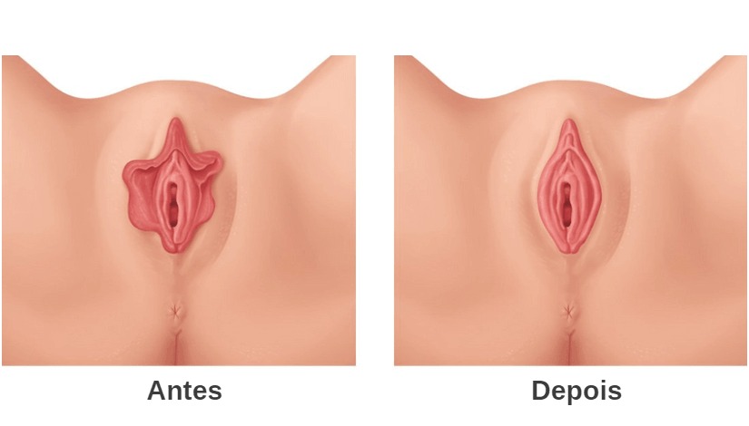 Cuidados posteriores à labioplastia