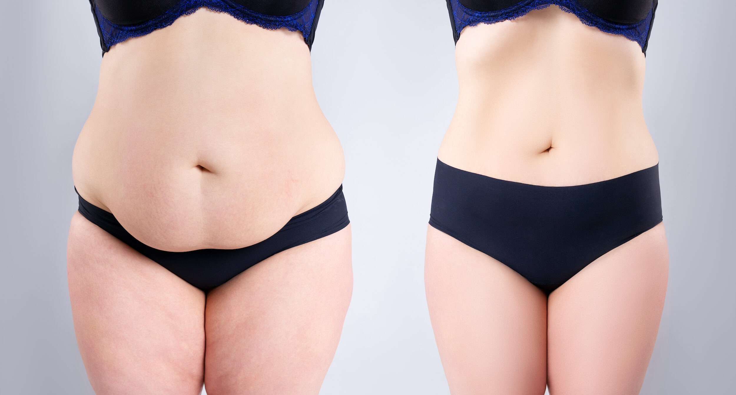 Dicas para ajudar você a se recuperar da sua mommy makeover