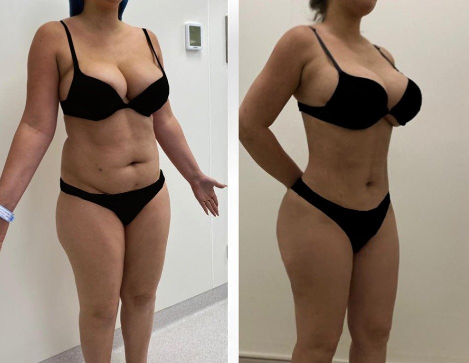 Dicas para ajudar você a se recuperar da sua mommy makeover