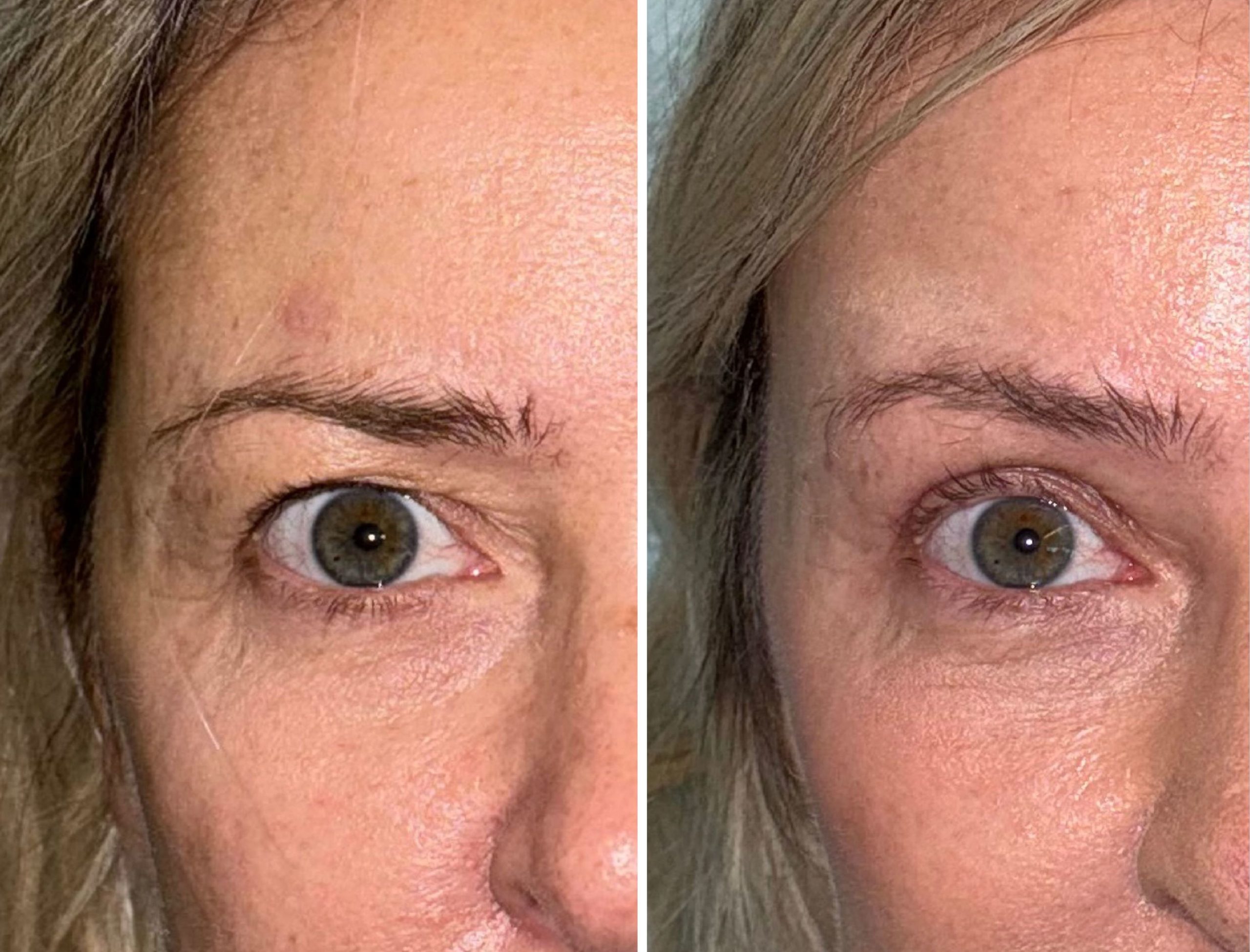 Diferenças do lifting facial profundo e do lifting facial tradicional