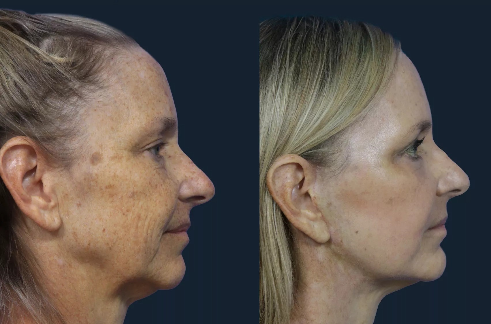 Diferenças do lifting facial profundo e do lifting facial tradicional