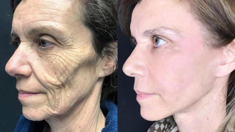 Diferenças do lifting facial profundo e do lifting facial tradicional