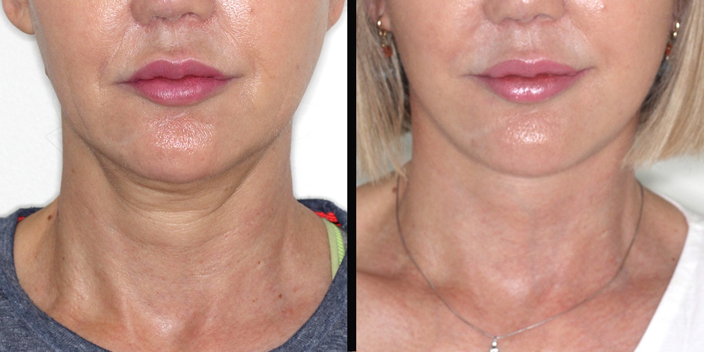 O Segredo para um Rejuvenescimento Facial Completo