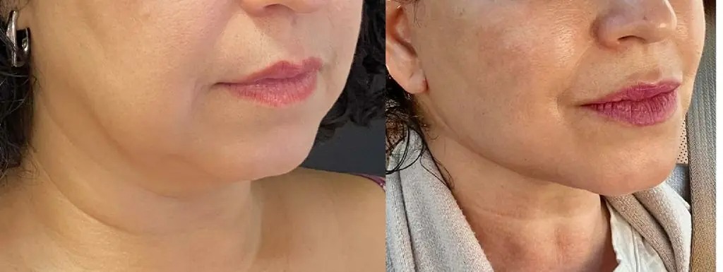 O Segredo para um Rejuvenescimento Facial Completo