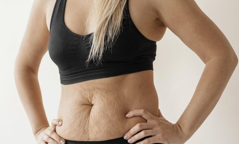 Recuperação da Mommy Makeover