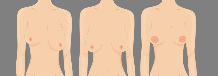 O que causa assimetria mamária e como corrigi-la