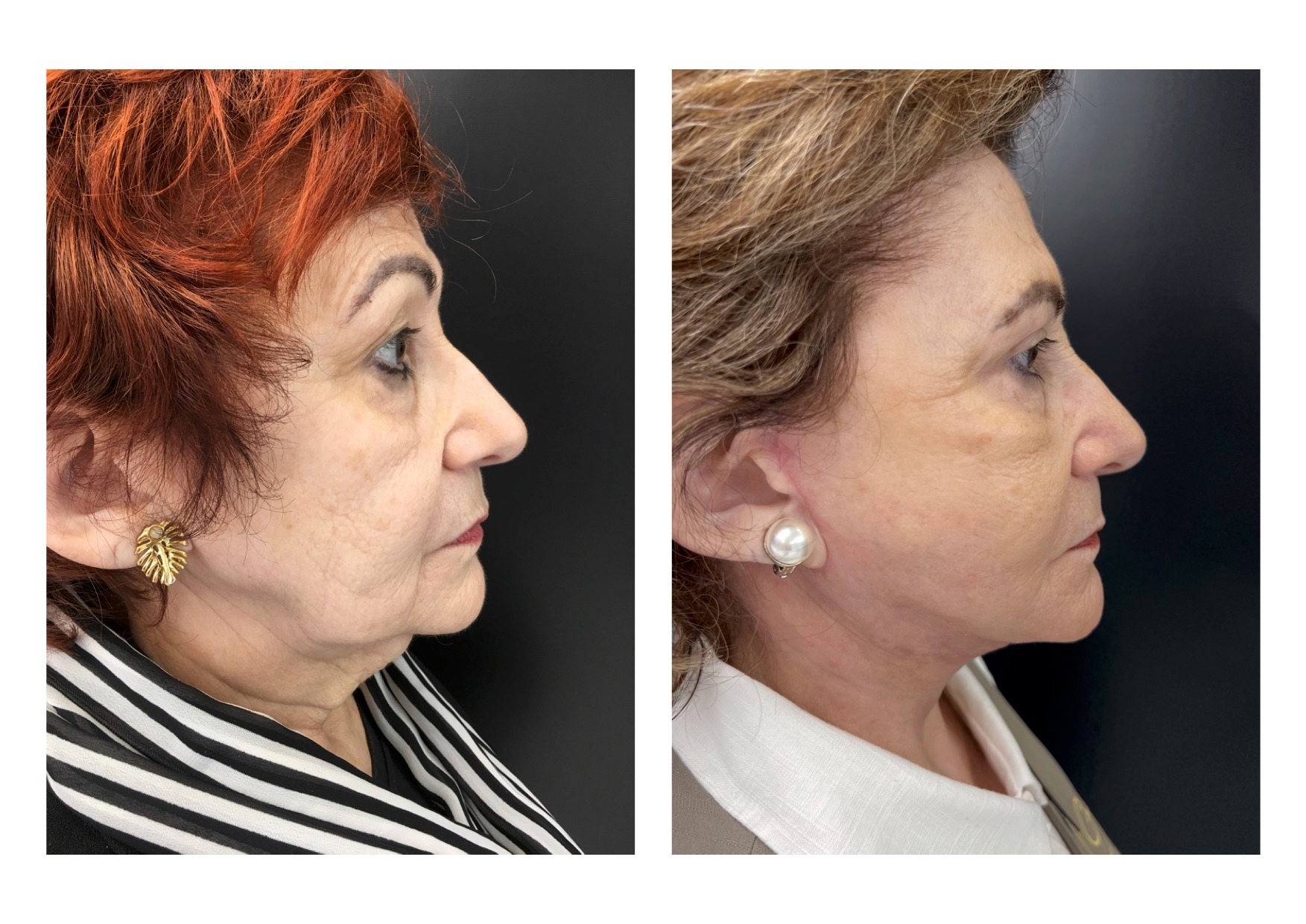 qual técnica é melhor para você?