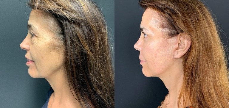 qual técnica é melhor para você?