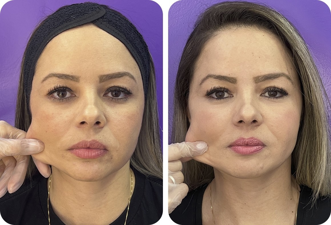 o ácido polilático é a melhor opção para você?